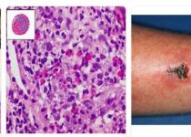 eosinophilic granulomatosis with polyangiitis